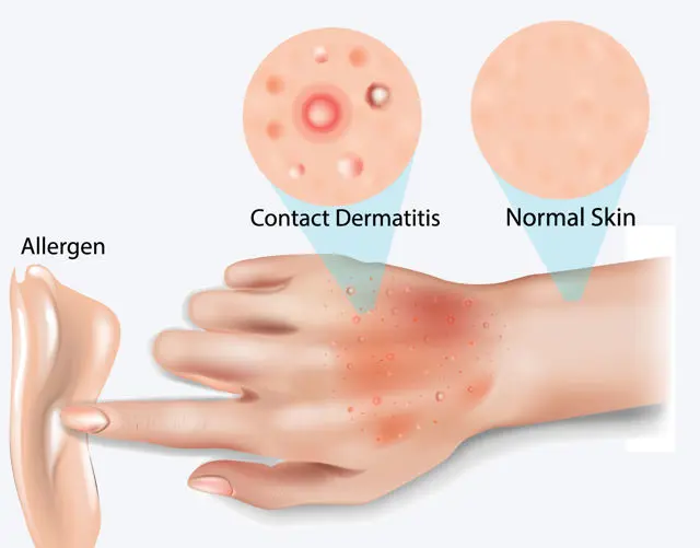 Contact Dermatitis 