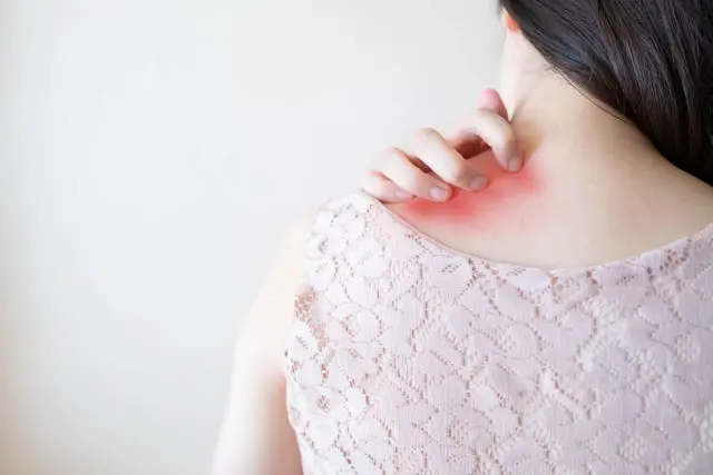 de urticaria