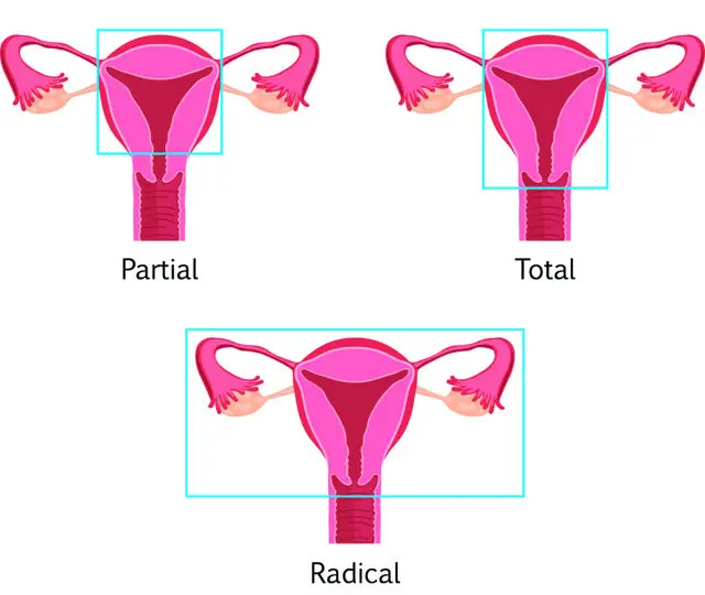 Hysterectomy Surgery