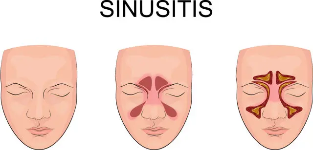 Sinusitis Treatment