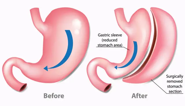 Sleeve Gastrectomy 