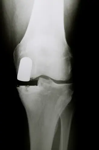Partial Knee Replacement Surgery