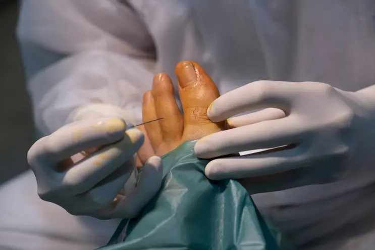 Minimally Invasive Foot Surgery
