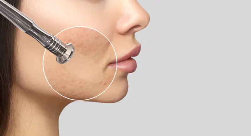 Laser CO2 Fractional trong tái tạo bề mặt da