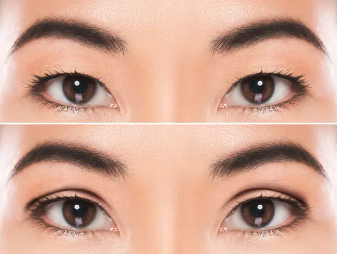 Single fold clearance eyelid