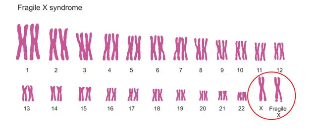 Fragile X Syndrome Genetic Test