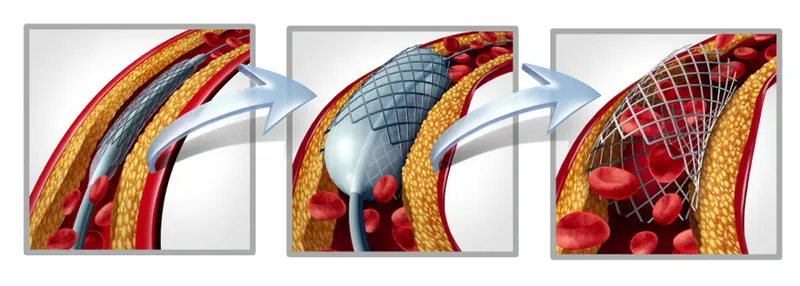 Advanced Invasive Cardiology Services