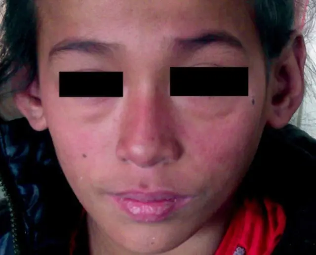 Sle systemic lupus erythematosus treatment