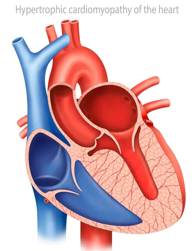 Hypertrophic Cardiomyopathy Management