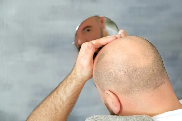 Benefit From Hair Transplantation