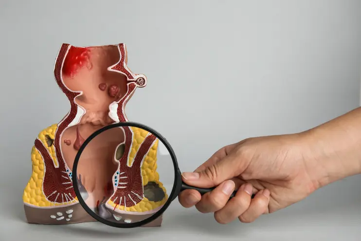 PSARP Surgery for Anorectal Malformations