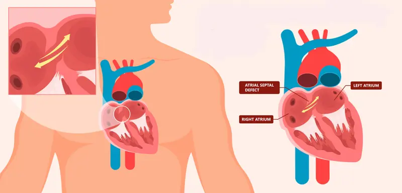 ASD (Atrial Septal Defect) Repair