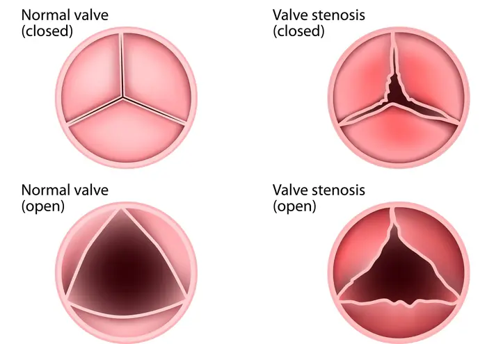 Heart Valve Disease Treatment