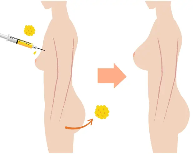 Breast fat grafting