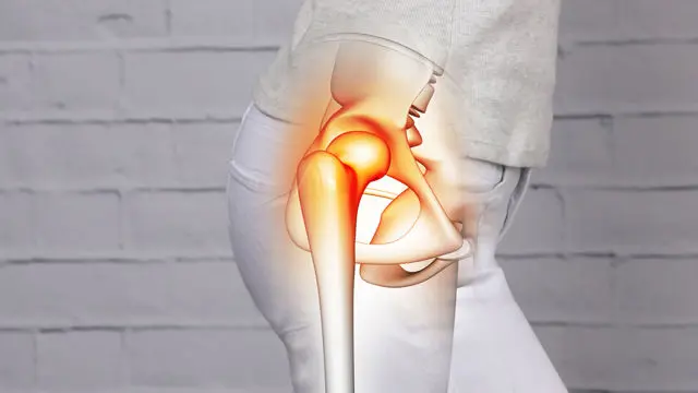 Hip Arthritis (Coxarthrosis) Treatment