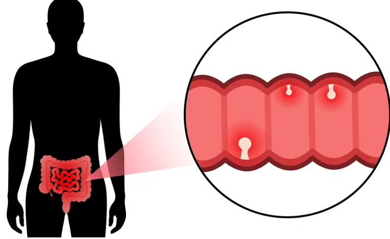 Endoscopic Polyp Removal