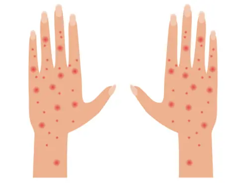 Skin Vasculitis (Cutaneous) Care
