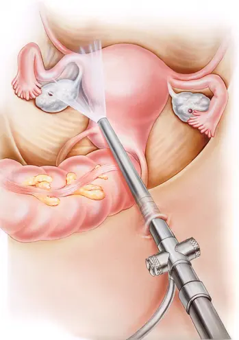 Endoscopia Ginecológica