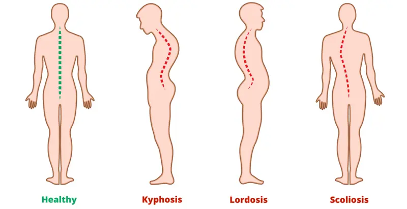 Scoliosis and Spinal Deformity Correction