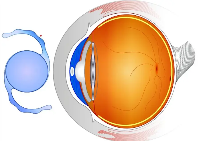 Toric Multifocal IOL