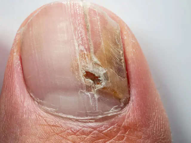Diabetes-Related Foot Infections: Diagnosis and Treatment | AAFP