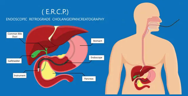 Bile Duct Cancer Treatment