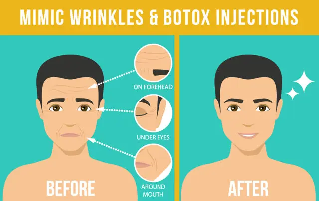botox