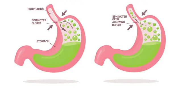 Gastroesophageal reflux disease (GERD)