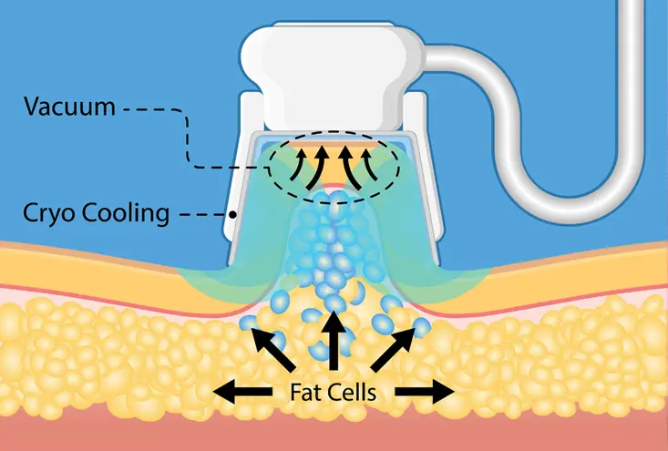 During Cryolipotherapy Treatment