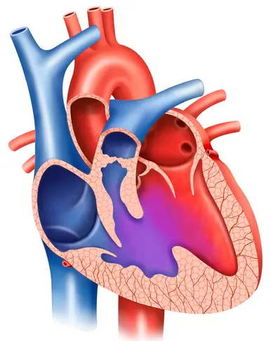 Ventricular Septal Defect (VSD)