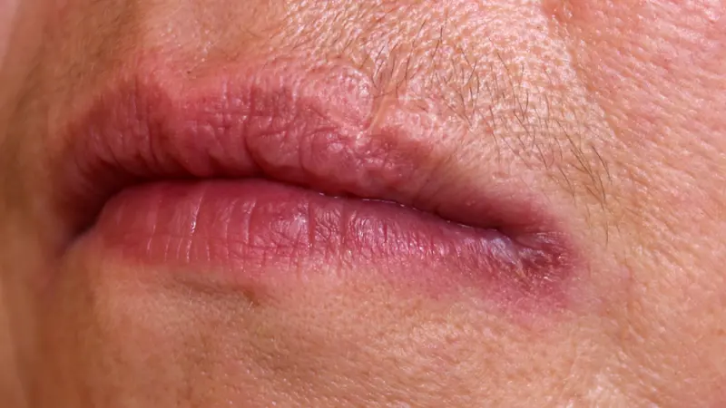 Angular Cheilitis: Causes, Symptoms, Treatment