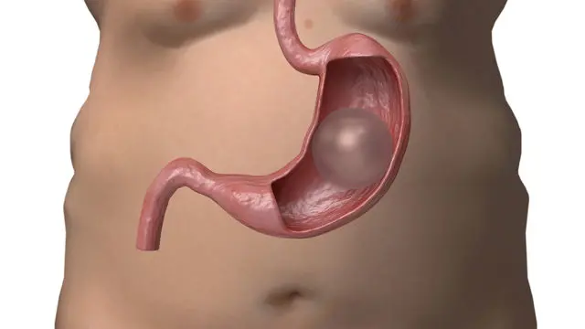 Gastric Balloon Weight Loss Procedure