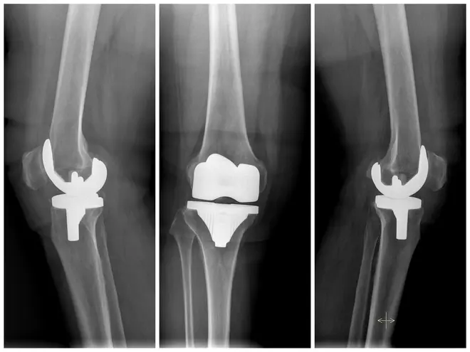 Comprehensive Joint Reconstruction Surgery