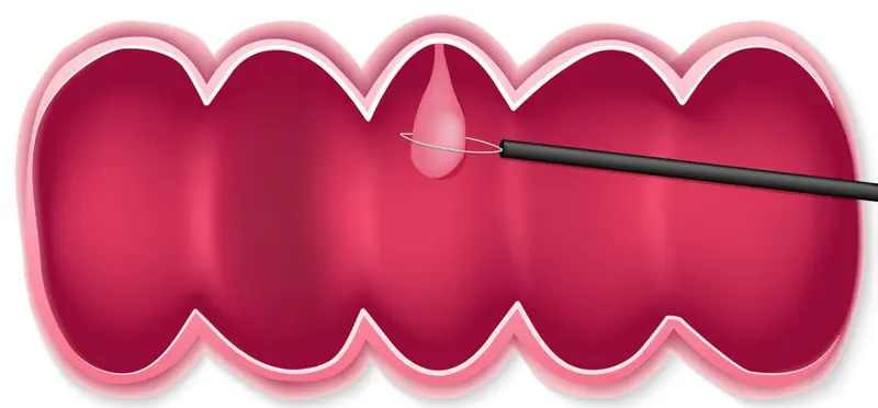 การผ่าตัดส่องกล้อง Polypectomy