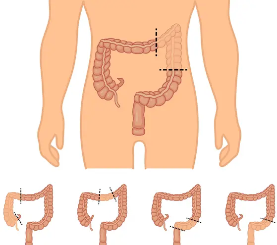 Robotic-Assisted Colectomy Surgery
