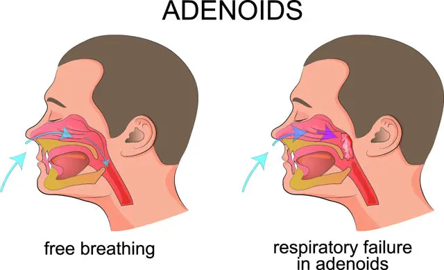 adenoidectom-a