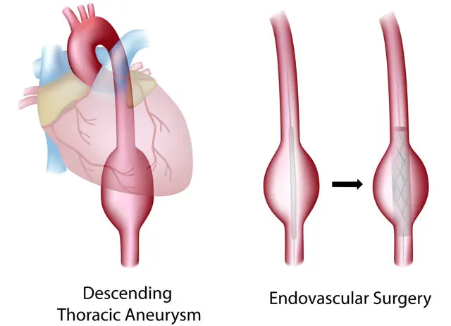 Aneurysm: A Complete Guide to Causes, Symptoms, and Treatment Options