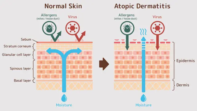 Atopic Dermatitis Treatment
