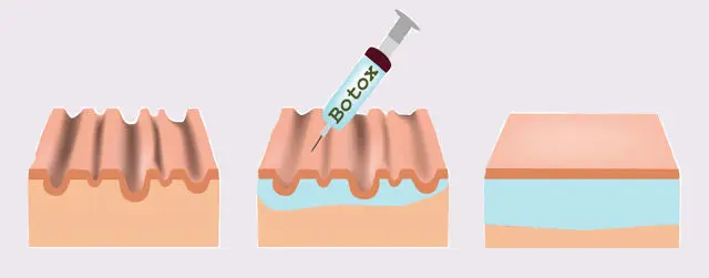Botox Injections for Wrinkles