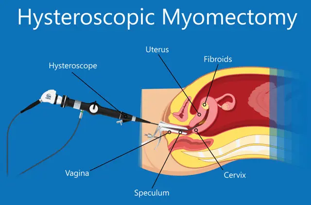 Hysteroscopic Myomectomy _ Office Hysteroscopy Procedure – FLDH