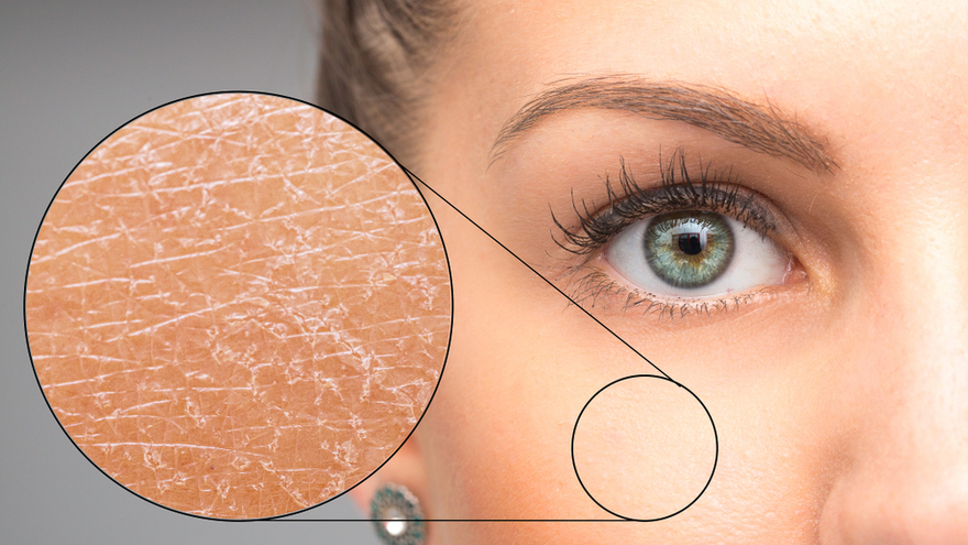 Dry Skin (Xerosis): A Complete Guide to Causes, Symptoms, and Treatment ...