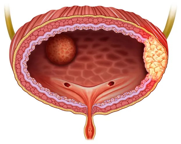 Bladder Removal Surgery (Cystectomy)