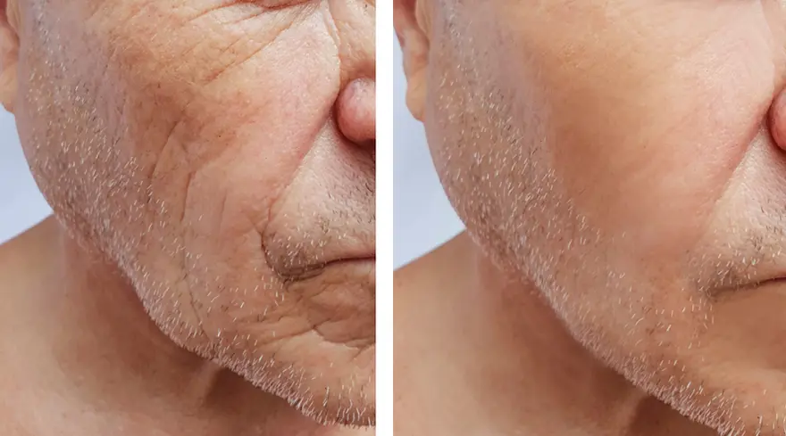Hydra Facial