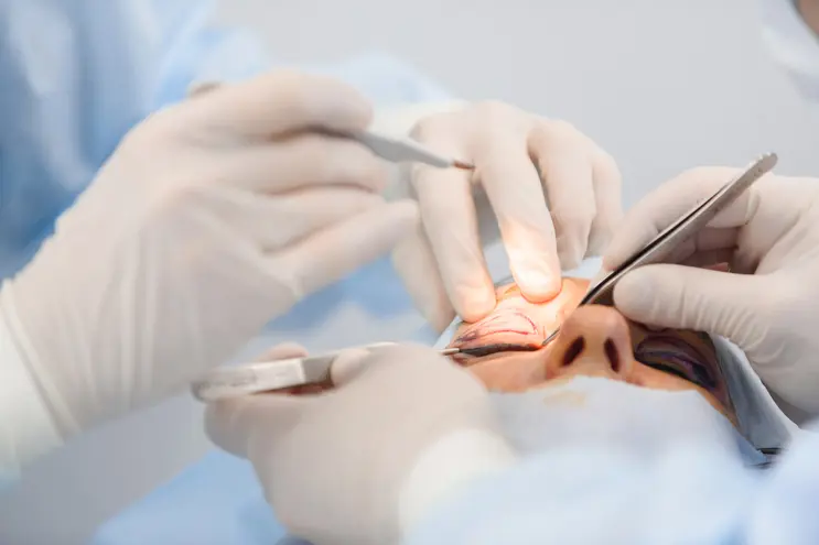 Eye Corner Surgery (Canthoplasty)