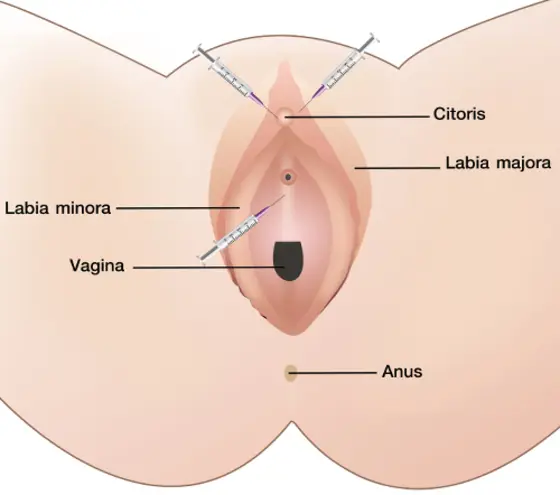 G Spot Surgery