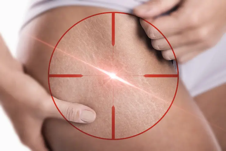 Laser Skin Treatment