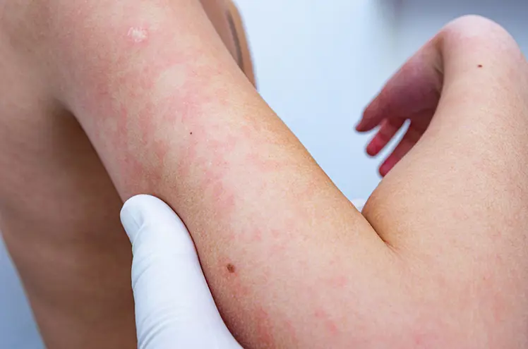 Eczema (Dermatitis)