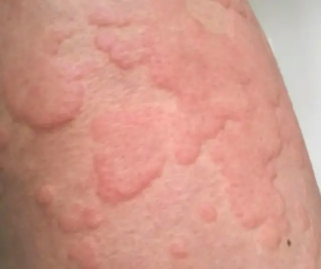 Аллергический васкулит кожи