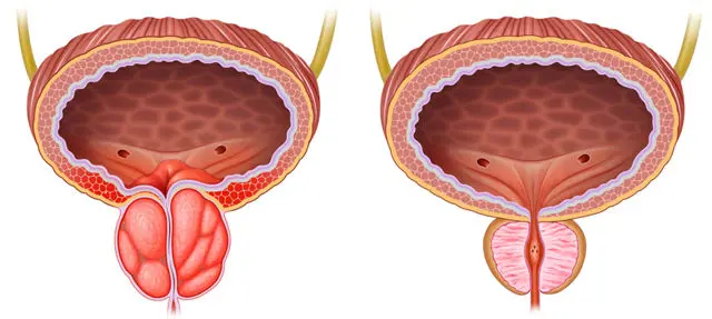 Benign Prostatic Hyperplasia (BPH) Treatment