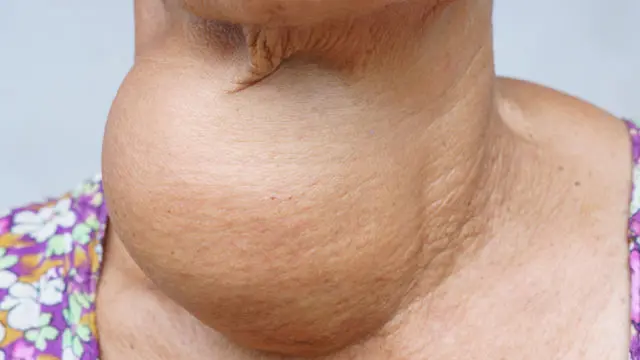 Endemic Goiter Treatment and Prevention